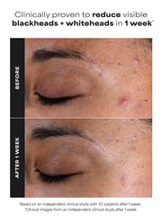 Travel Size 2% BHA Liquid Exfoliant
